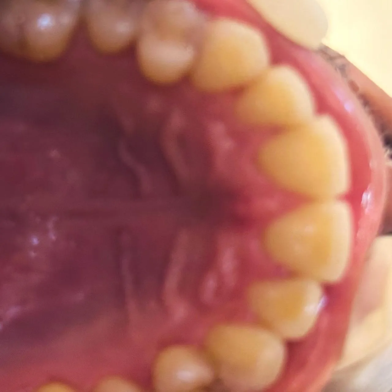 After: View of the upper jaw from below, with a complete row of evenly spaced teeth