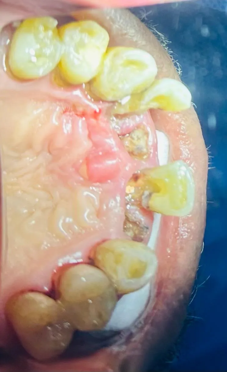 Before: View of the upper jaw from below, with teeth broken down to the gum and decayed roots