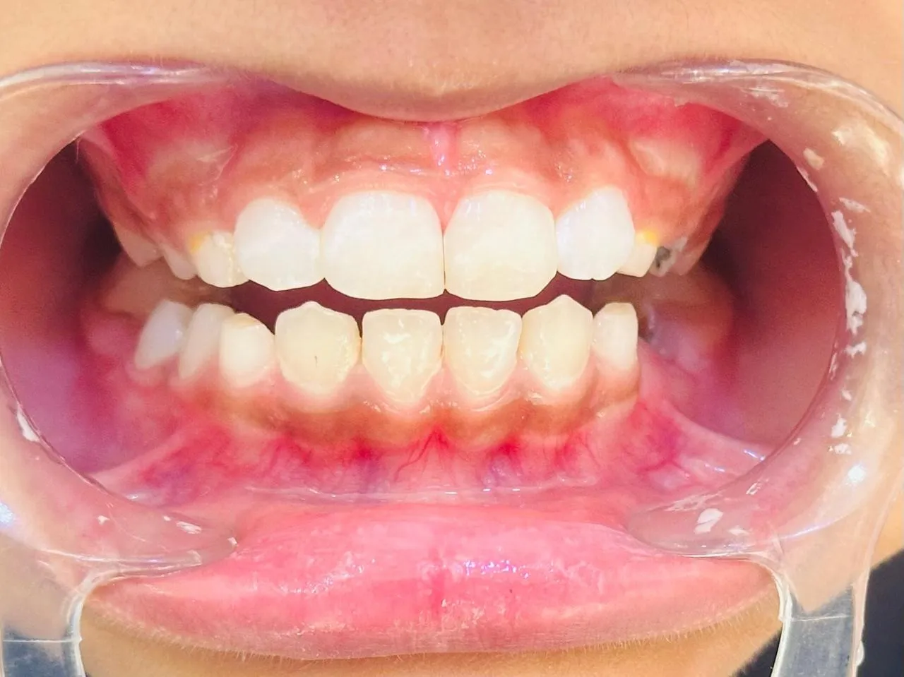 After: The same child’s front teeth with the broken tooth rebuilt to match its neighbour