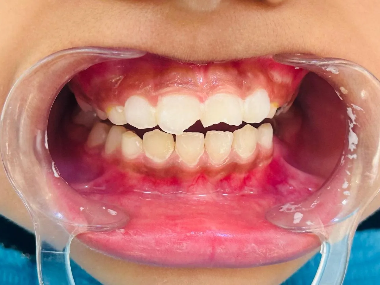 Before: A child’s front teeth with a corner broken off one upper front tooth