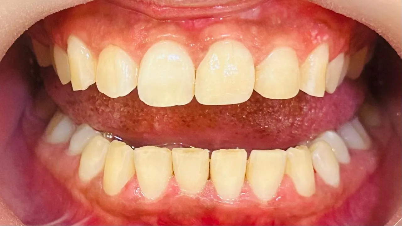 After: Close-up of the repaired upper front teeth, even in shape and shade