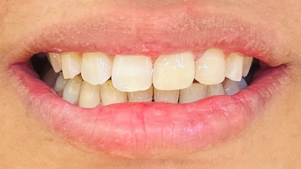After: Smile showing the same front teeth with even edges and colour