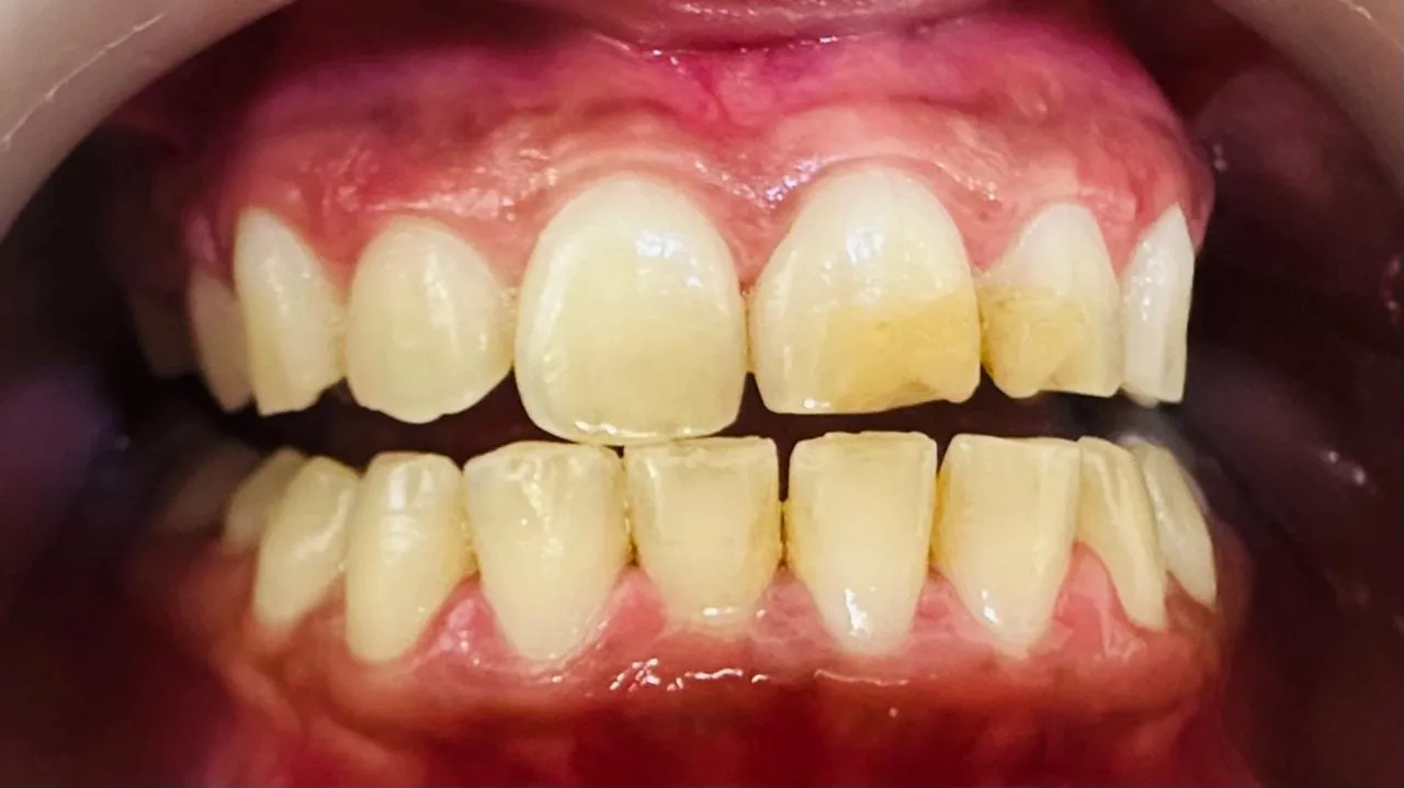 Before: Close-up of upper front teeth with chipped edges and yellow-brown patches
