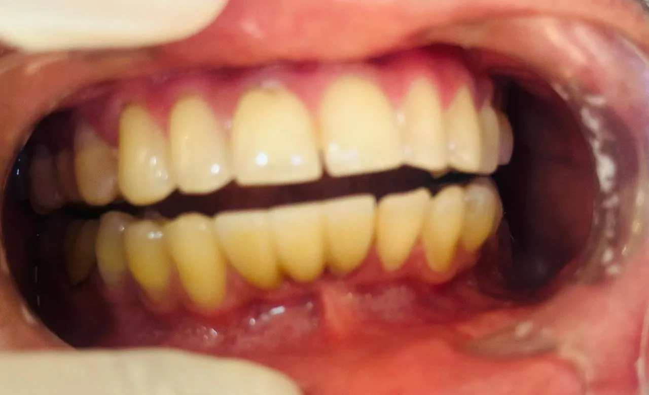 After: Full, evenly aligned upper and lower teeth with healthy-looking gums