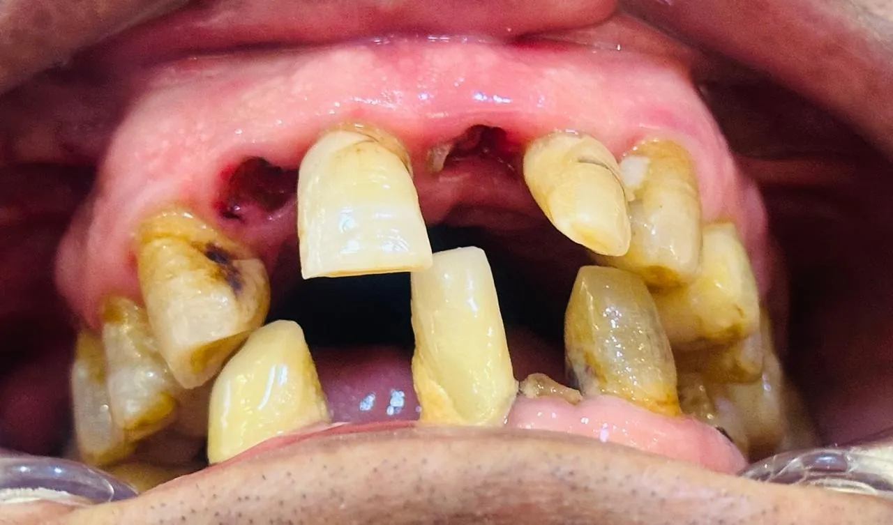 Before: Upper front teeth drifted apart and decayed, with gaps and inflamed gums