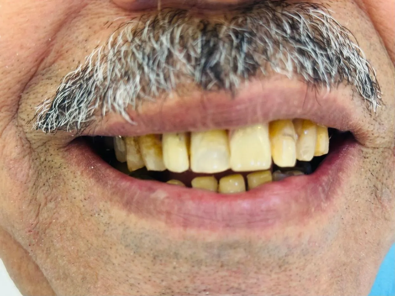 After: The same smile with a complete, even row of front teeth