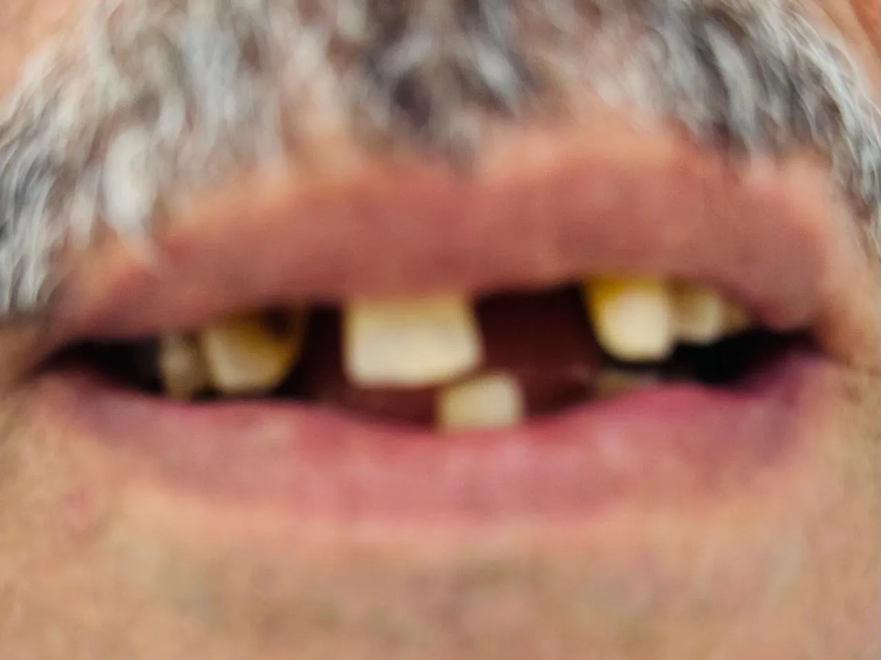 Before: An older man’s smile with several front teeth missing and wide gaps