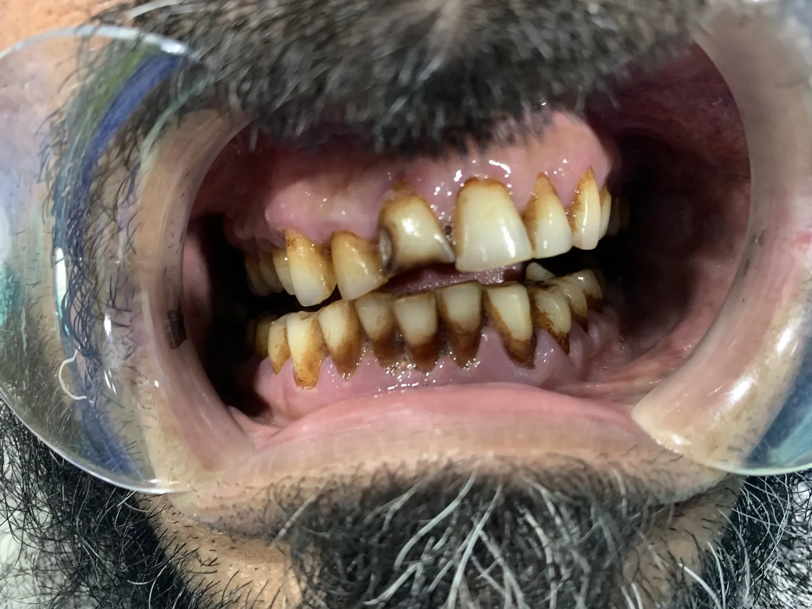 Before: Upper and lower teeth with heavy brown paan stains, wear and a decayed upper front tooth