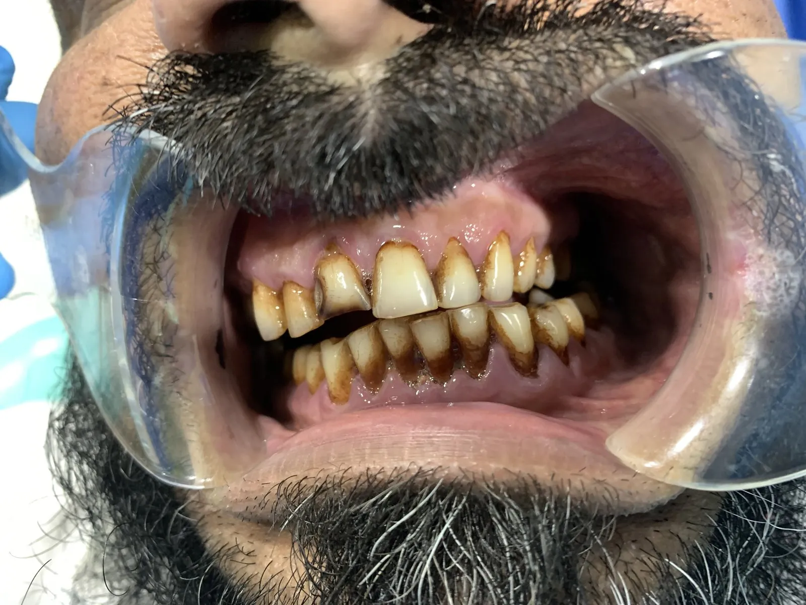 Side view: worn teeth with grooves at the gum line