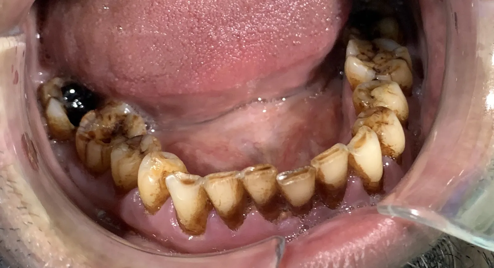 Lower back teeth from above, worn down with erosion cavities