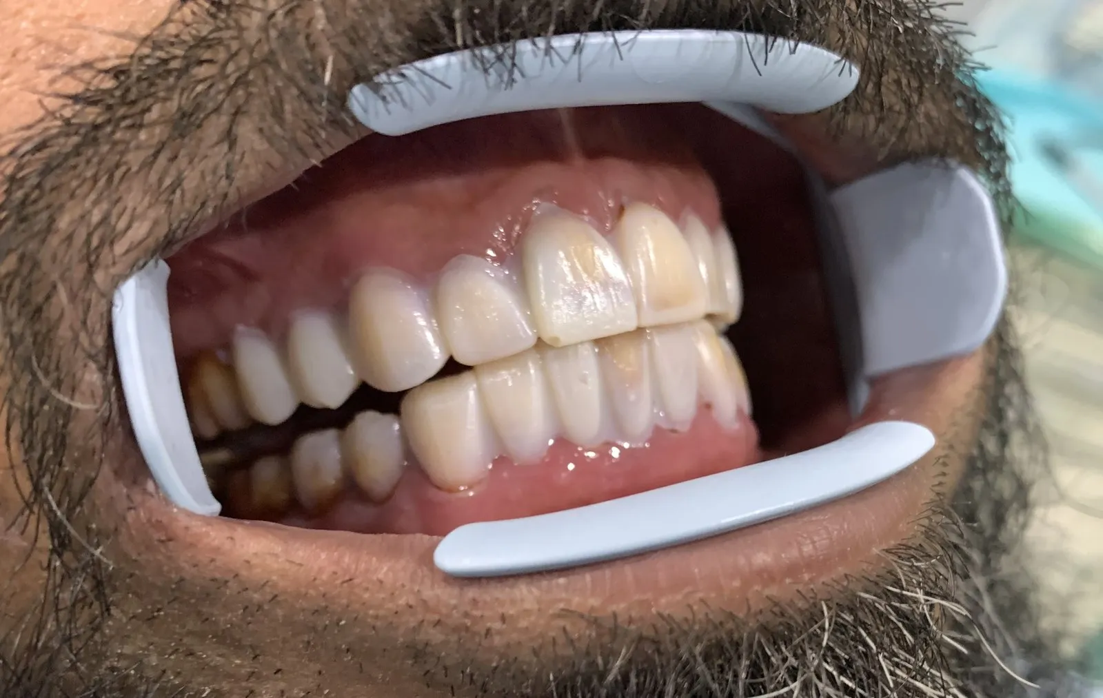 The temporary mock-up on the front teeth, seen from the side