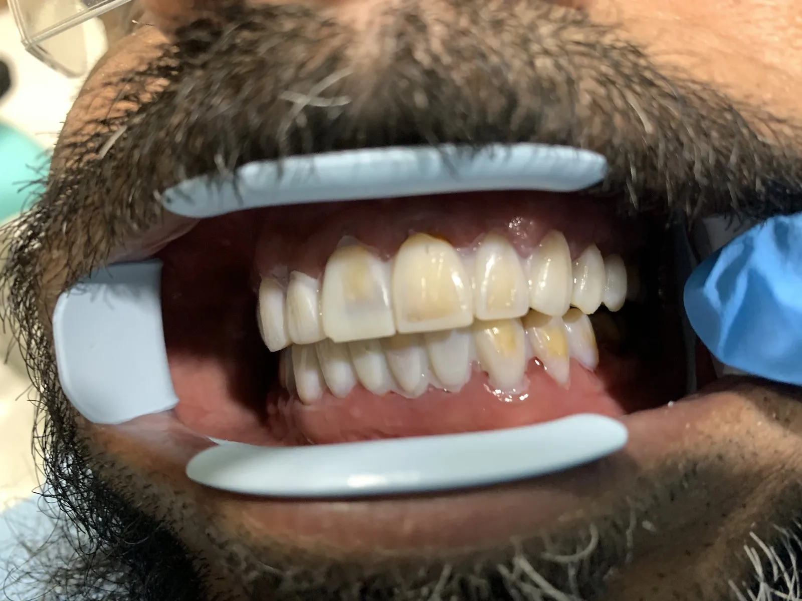 The mock-up in place after the back teeth were filled
