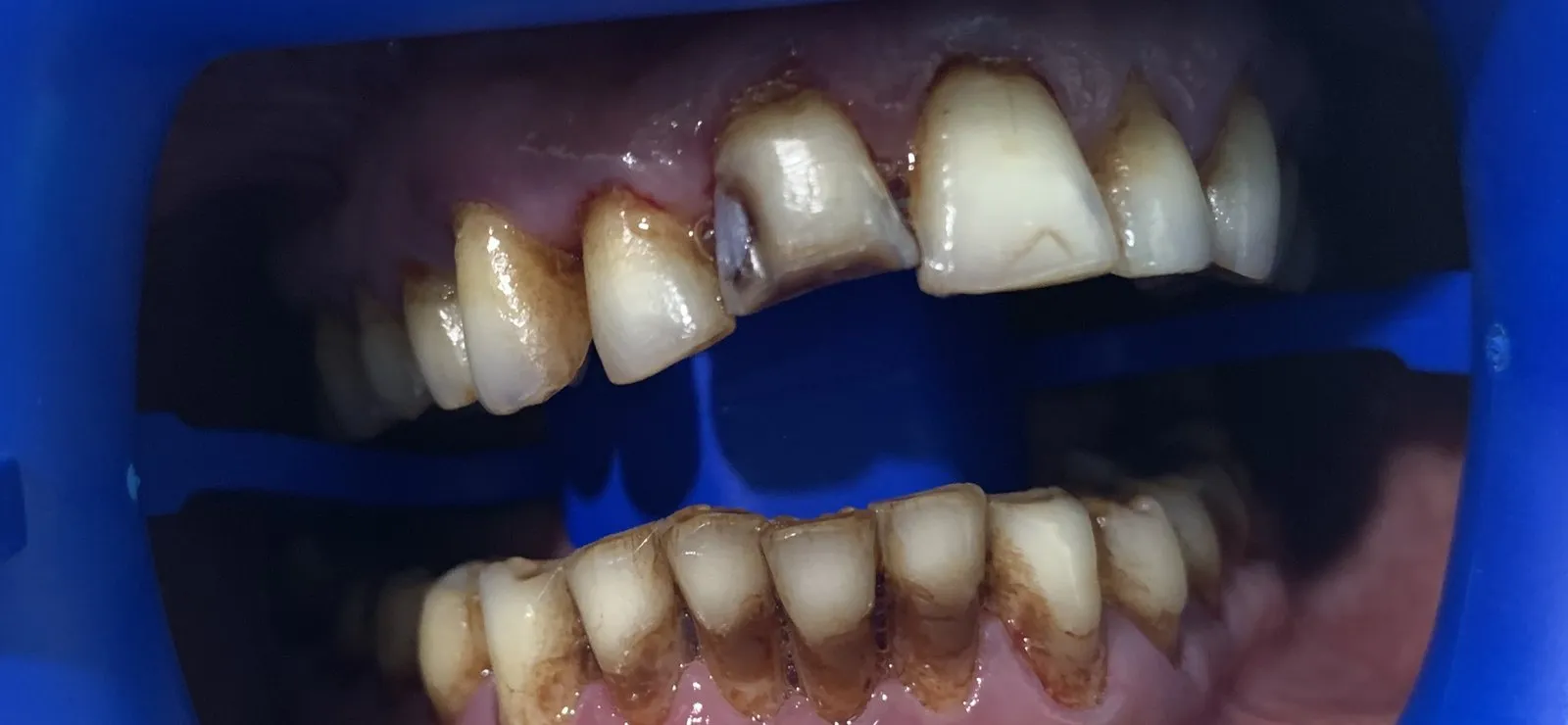 The teeth before whitening, with a temporary repair on the upper front tooth