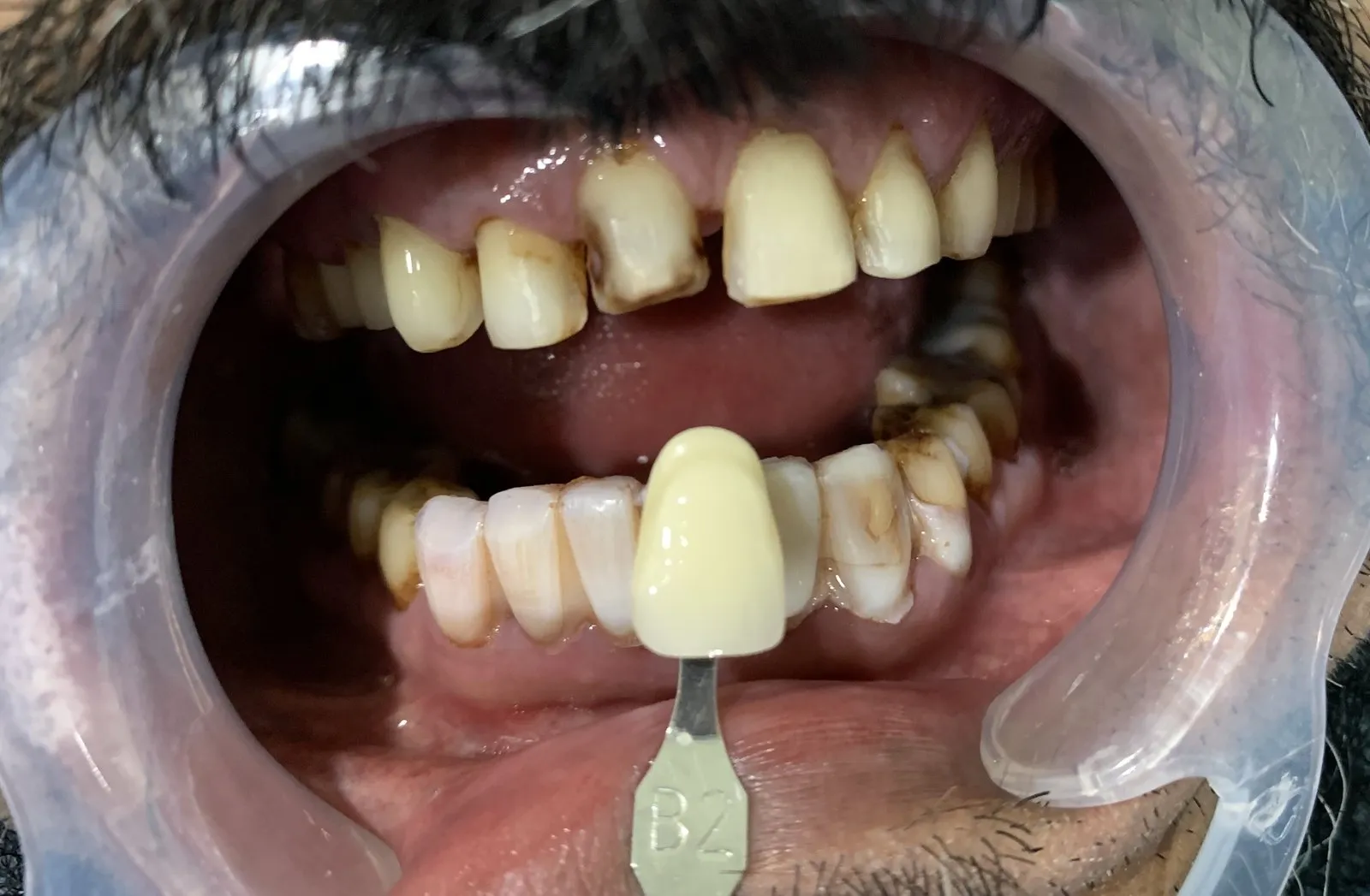 Choosing the shade against the whitened teeth