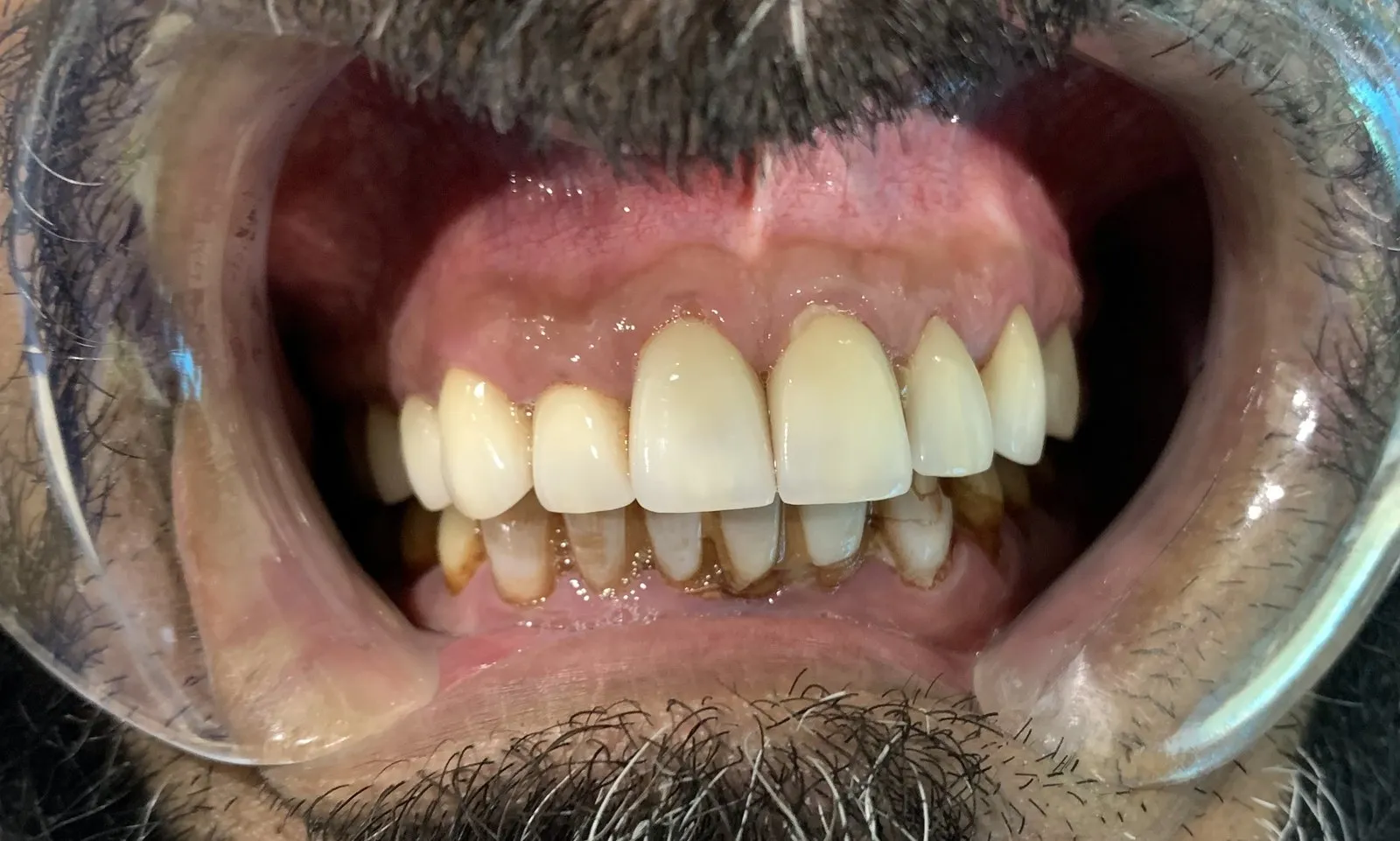The upper ceramic veneers in place, front view