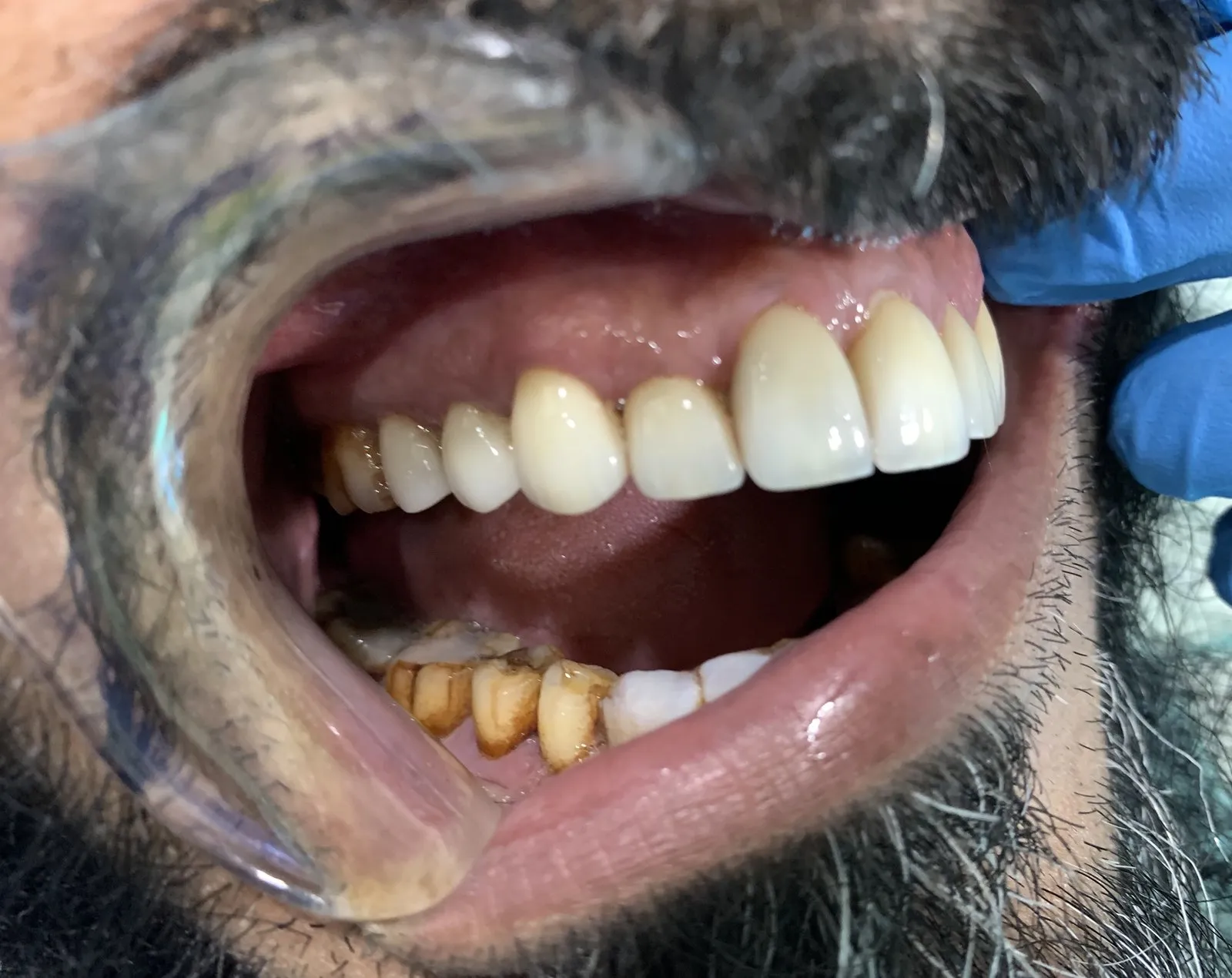The upper veneers from the right
