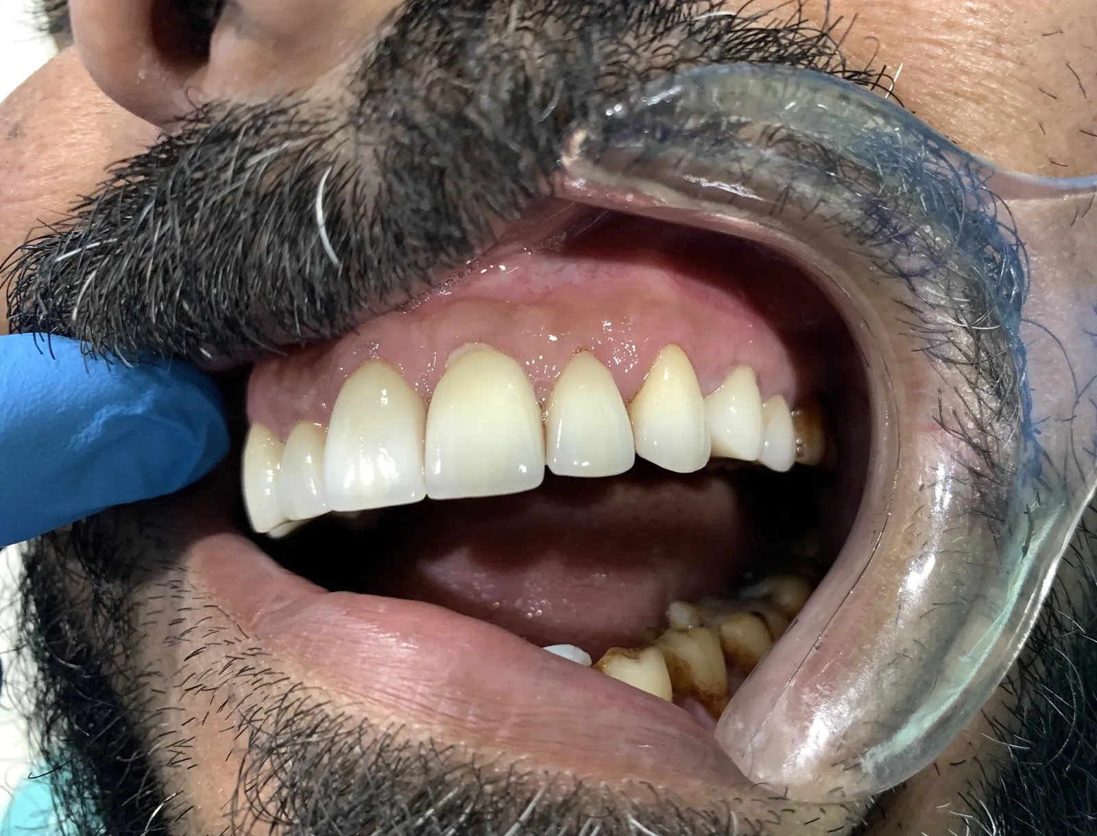 The upper veneers from the left