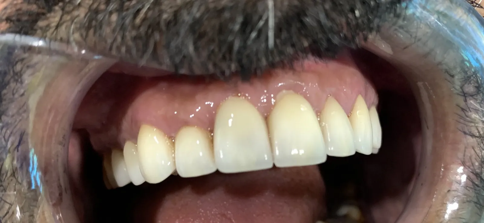 Healthy gums around the upper veneers after repeated cleaning