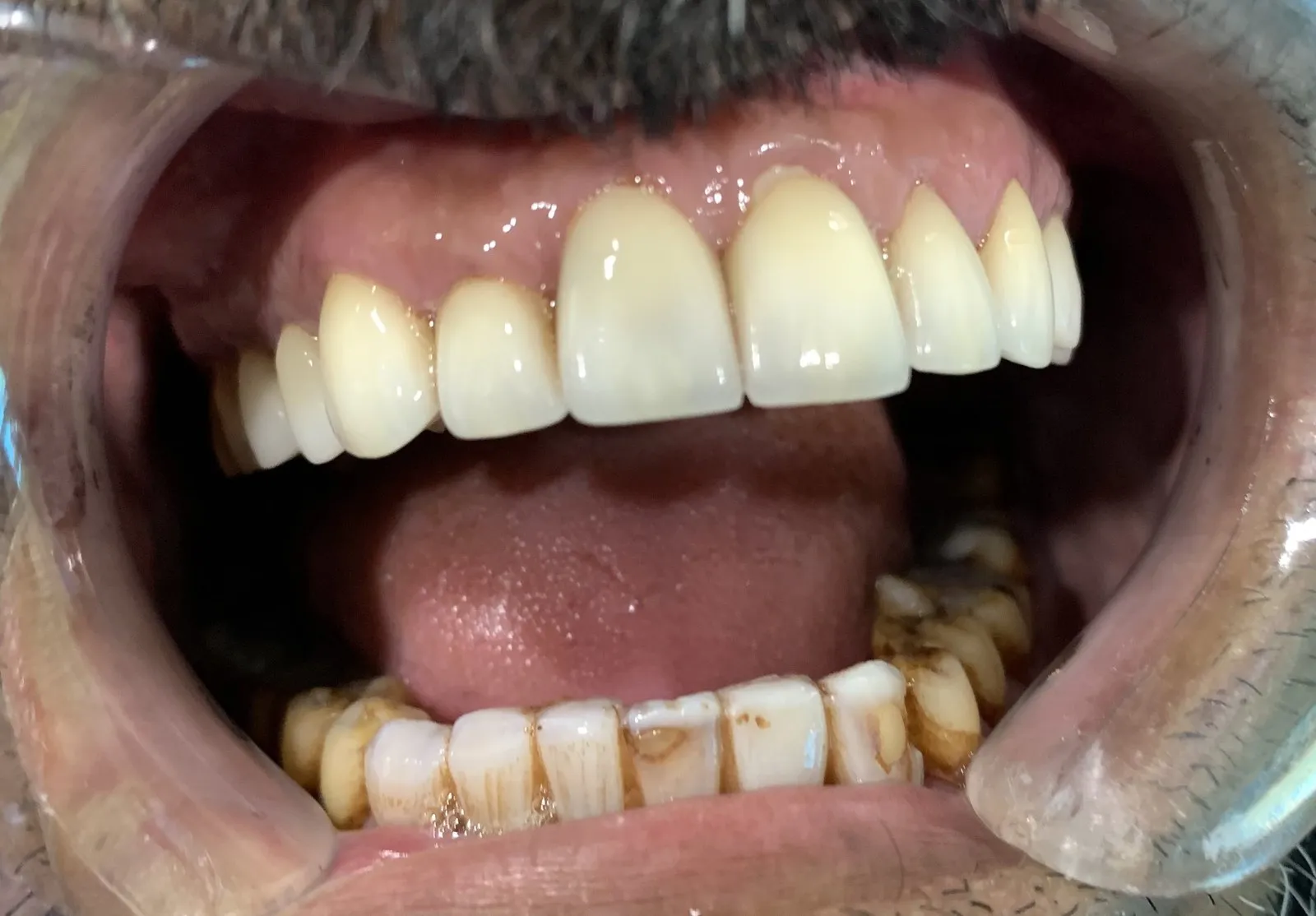 Upper veneers in place, with the lower teeth awaiting their veneers