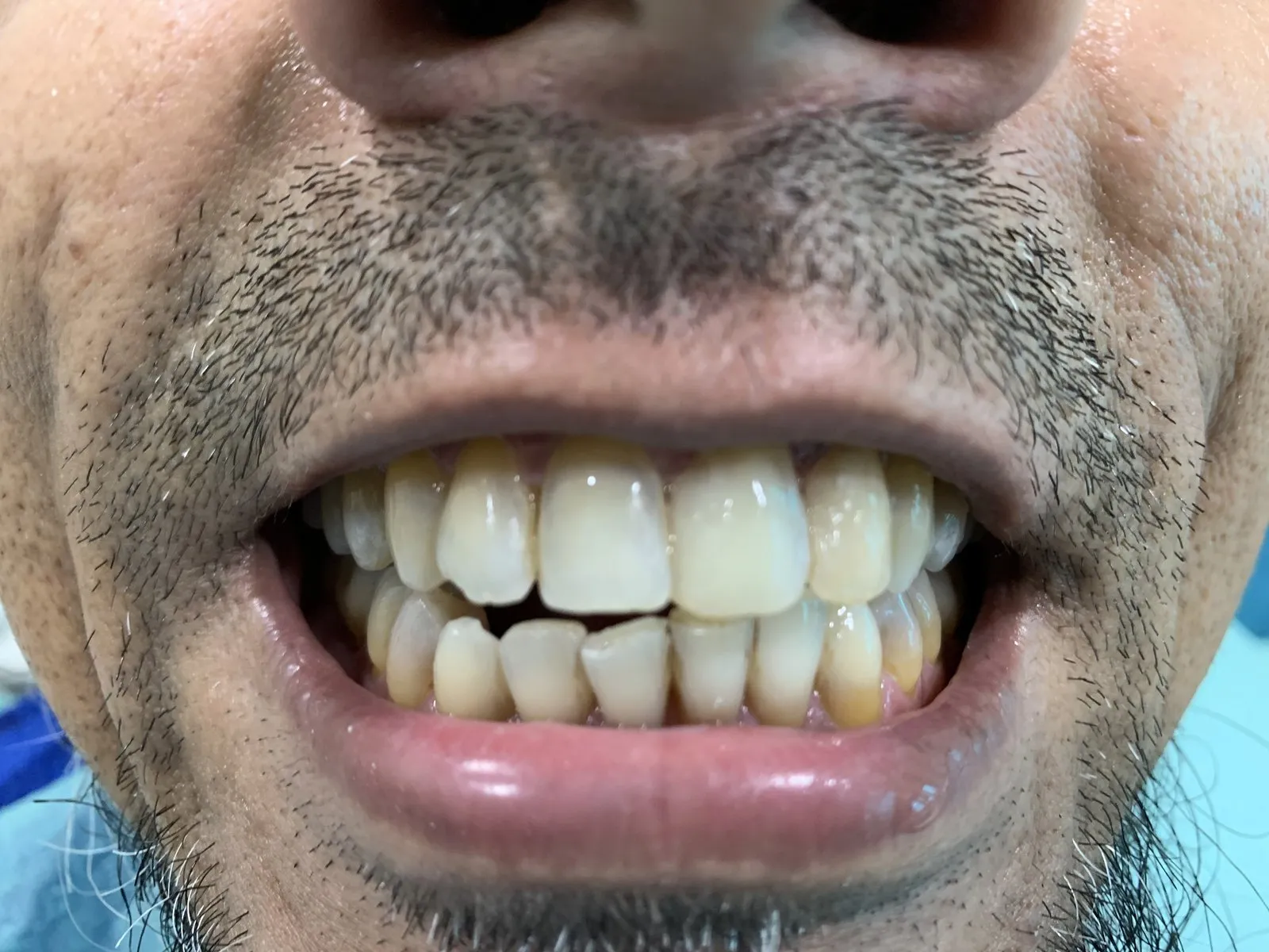 After: The same smile after whitening, noticeably lighter and brighter