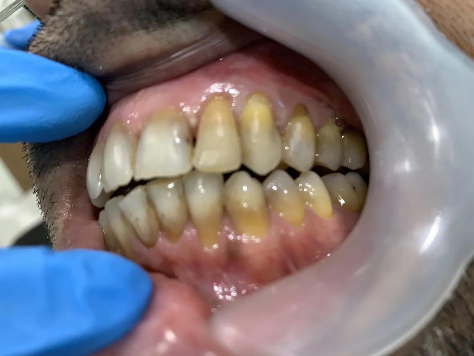 Stained teeth, left side