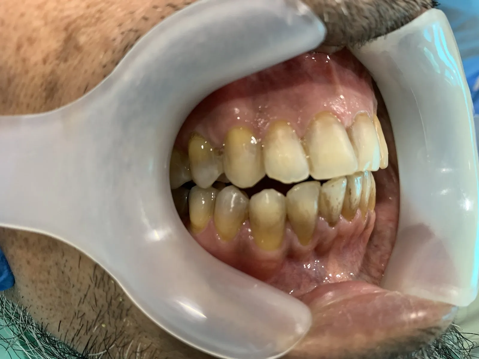 Stained teeth, right side