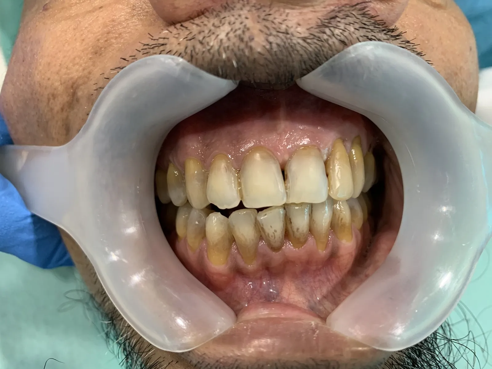 Before: Front view of yellow and brown stained teeth
